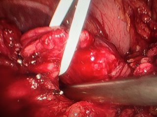 Cáncer de páncreas liberado de los vasos mesenterios y portales