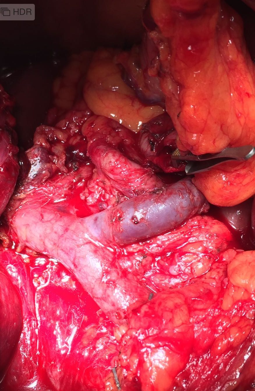 Estado final del área retropancreática una vez extirpado el tumor y los ganglios