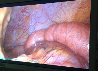 Visión laparoscópica de un abdomen libre de enfermedad un año después de haber sidooperado de un cáncer de páncreas