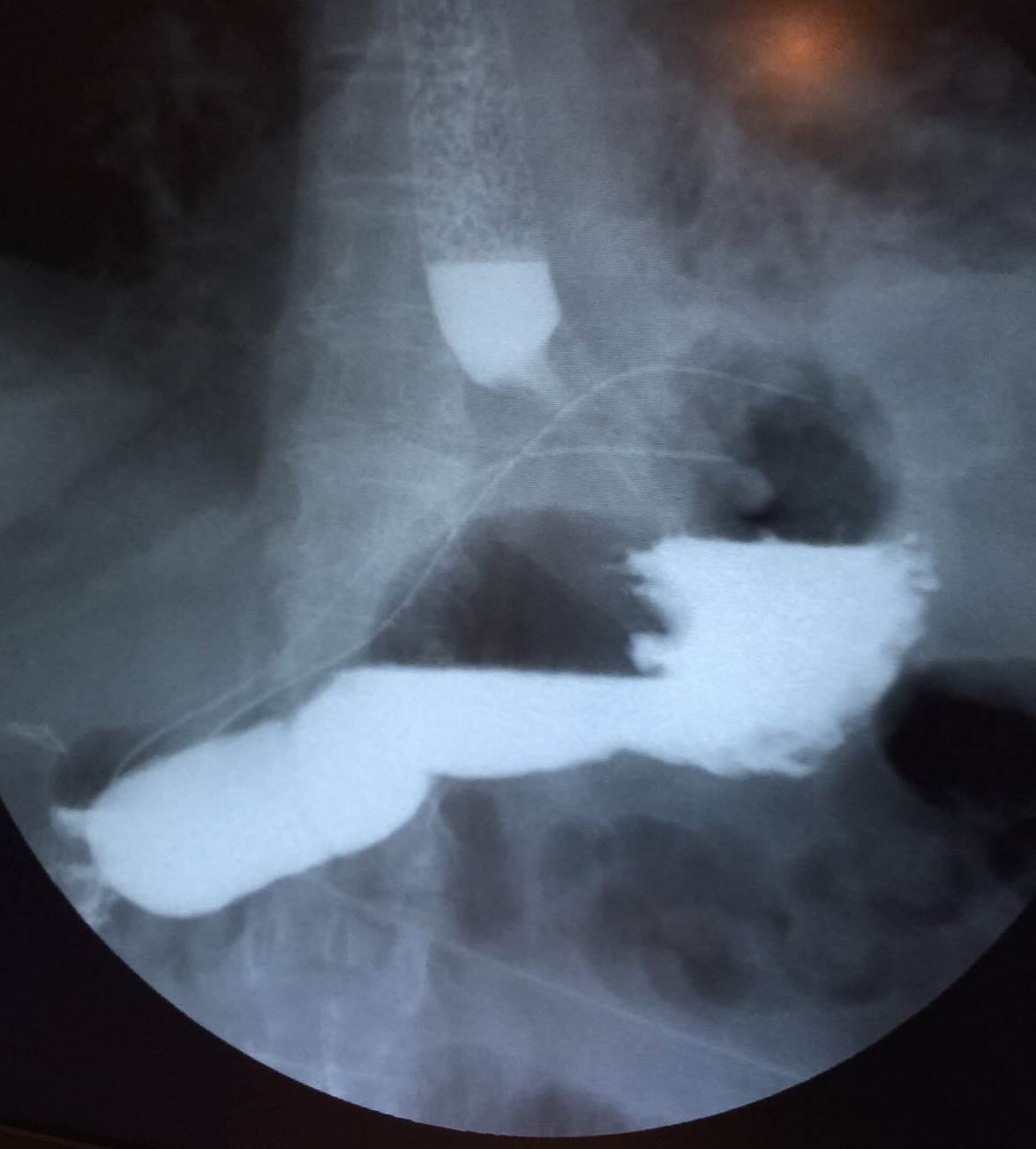 Imagen despues de la cirugía con el estómago en abdomen
