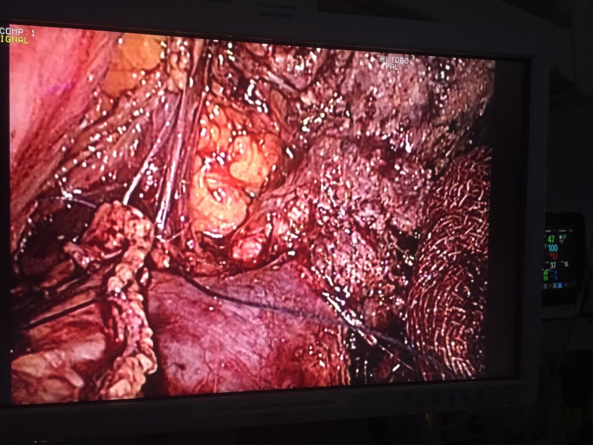 Borde de sección del páncreas extirpado el tumor