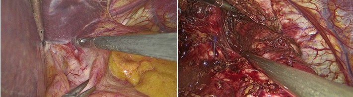 Imágenes intraoperatorias durante la disección del hiato esofágico